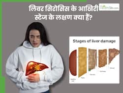 लिवर सिरोसिस के लास्ट स्टेज के सिम्पटम्स क्या हैं? जानें, इसके 5 गंभीर लक्षण