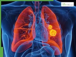 World Lung Cancer Day 2025: 7 Early Warning Signs of Lung Cancer You Should Never Ignore