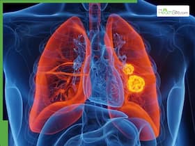 World Lung Cancer Day 2025: 7 Early Warning Signs of Lung Cancer You Should Never Ignore