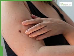 5 Early Warning Signs Your Mole Could Be Cancerous, Know Other Symptoms And Risk Factors