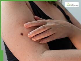 5 Early Warning Signs Your Mole Could Be Cancerous, Know Other Symptoms And Risk Factors 5 Early Warning Signs Your Mole Could Be Cancerous, Know Other Symptoms And Risk Factors