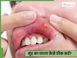 गर्मी से होने वाले मुंह के छाले कैसे ठीक करें? डॉक्टर से जानें