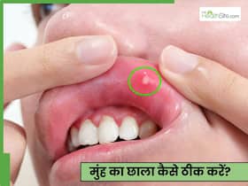 गर्मी से होने वाले मुंह के छाले कैसे ठीक करें? डॉक्टर से जानें