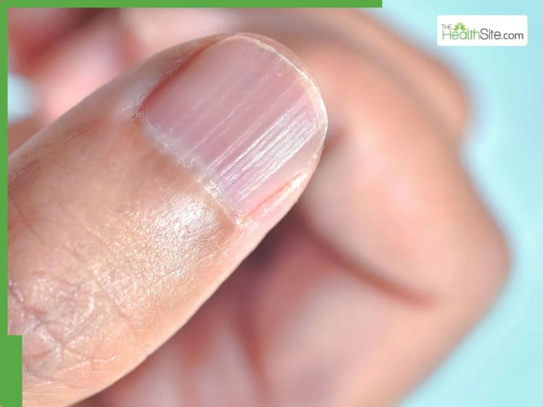 5 Warning Signs of Hypothyroidism Can Show Up In Your Nails