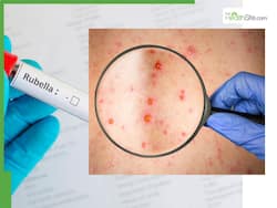 Nepal Eliminates Rubella, Highly Contagious German measles That Can Lead To Miscarriage, Stillbirth