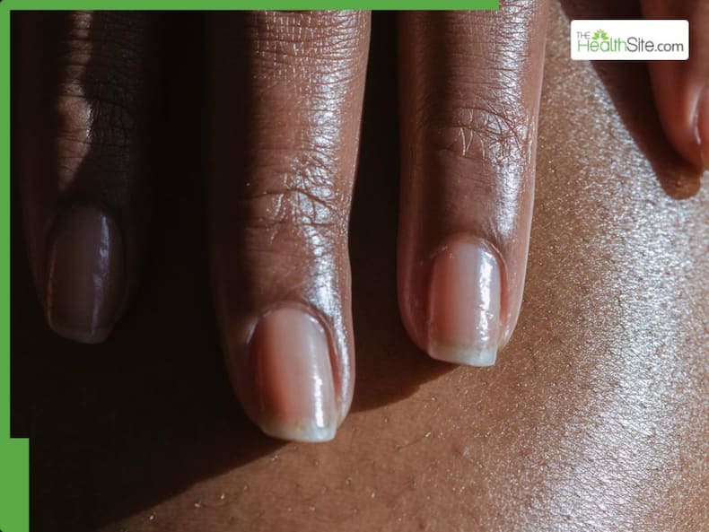 5 Warning Signs of Hypothyroidism Can Show Up In Your Nails
