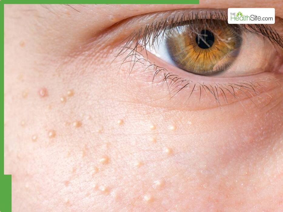 5 Warning Signs of High Cholesterol on the Face You Shouldn't Ignore