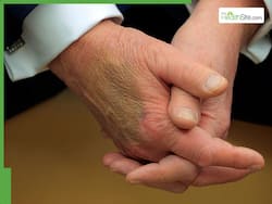 Donald Trump Health Updates: White House Answers About POTUS Repeated Hand Bruising On The Back Of His Right Hand