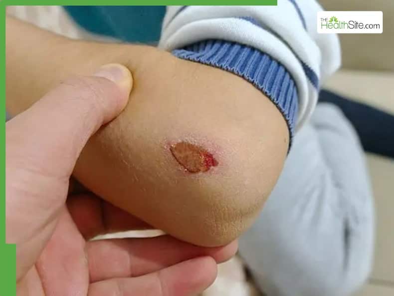 Skin Cancer Symptoms: 5 Warning Signs Of Skin Cancer You Should Never Ignore