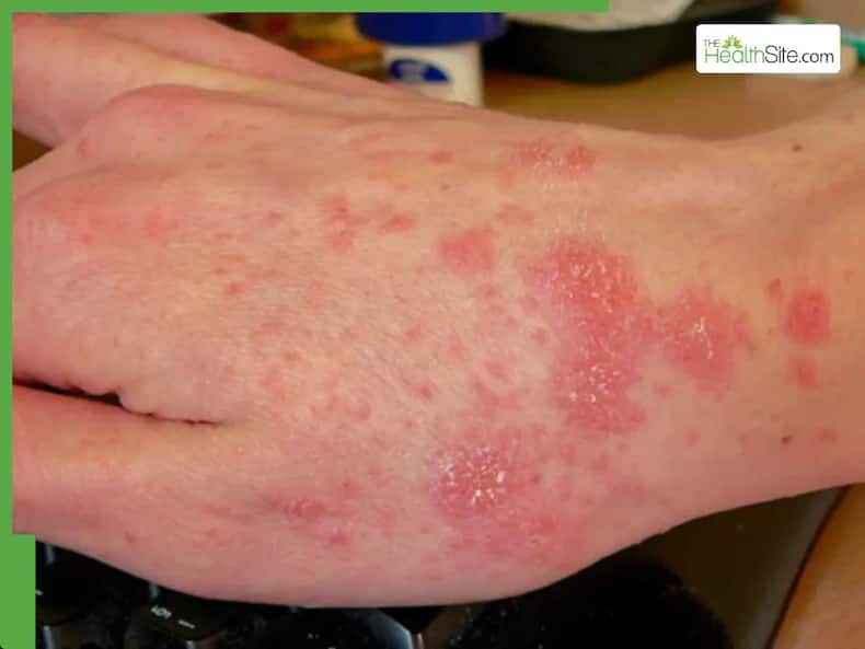 Skin Cancer Symptoms: 5 Warning Signs Of Skin Cancer You Should Never Ignore