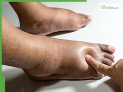5 Dangerous Diseases That Can Lead To Unusually Swollen Feet At Night