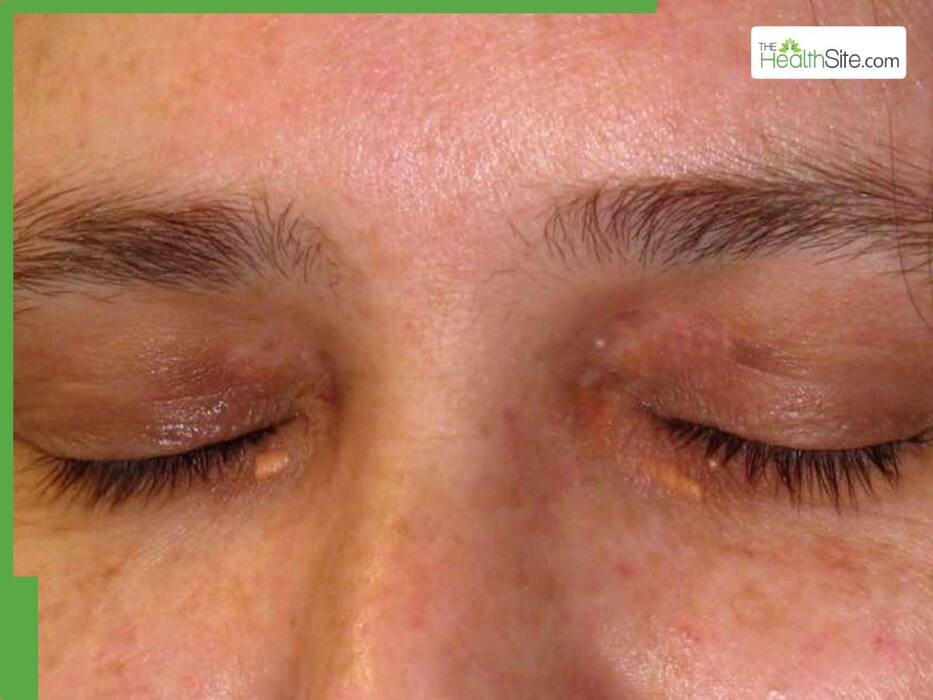 5 Warning Signs of High Cholesterol on the Face You Shouldn't Ignore