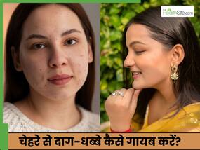 चेहरे पर दाग धब्बे किसकी कमी से होते हैं? 3 उपाय देंगे साफ-चमकदार स्किन चेहरे पर दाग धब्बे किसकी कमी से होते हैं? 3 उपाय देंगे साफ-चमकदार स्किन