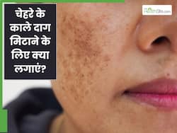 चेहरे के काले दाग हटाने के लिए क्या लगाएं? जानें 5 चीजें जिनसे दूर हो जाएगा कालापन