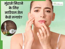 नारियल तेल से चेहरे के मुंहासे कैसे ठीक करें? जानें 5 तरीके, जिनसे मिट जाएंगे सारे एक्ने