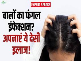 बालों के फंगल इंफेक्शन को दूर करेंगे ये घरेलू तरीके!
