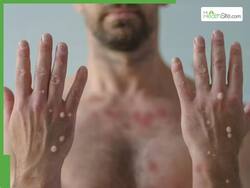 WHO ने चेताया अभी भी मंडरा मंकीपॉक्स का खतरा, जानें कैसे रखें अपने परिवार को सुरक्षित