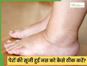 डॉक्टर से जानें कैसे ठीक करें पैरों की सूजी हुई नसें, 5 उपाय जो देंगे आराम ही आराम