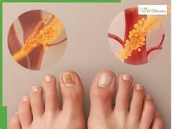 10 Warning Signs of High Cholesterol Warning Signs In Your Toe Nails