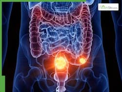 Colon Cancer Symptoms: 5 Early Warning Signs Of Colonic Carcinoma