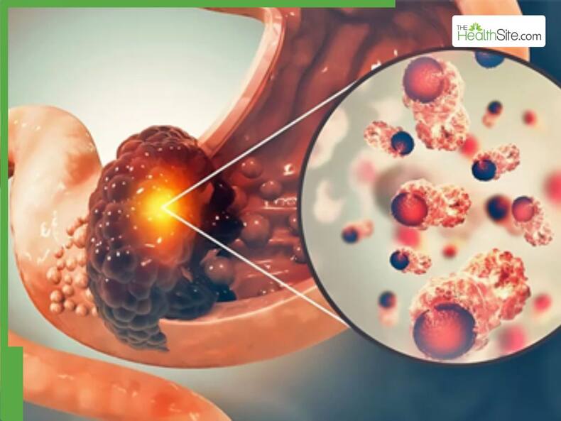 5 Fast-Growing Stomach Cancers Linked to Diet and Lifestyle Choices