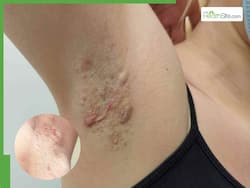 Blisters in Your Armpit? The Hidden Health Dangers You Need to Know About
