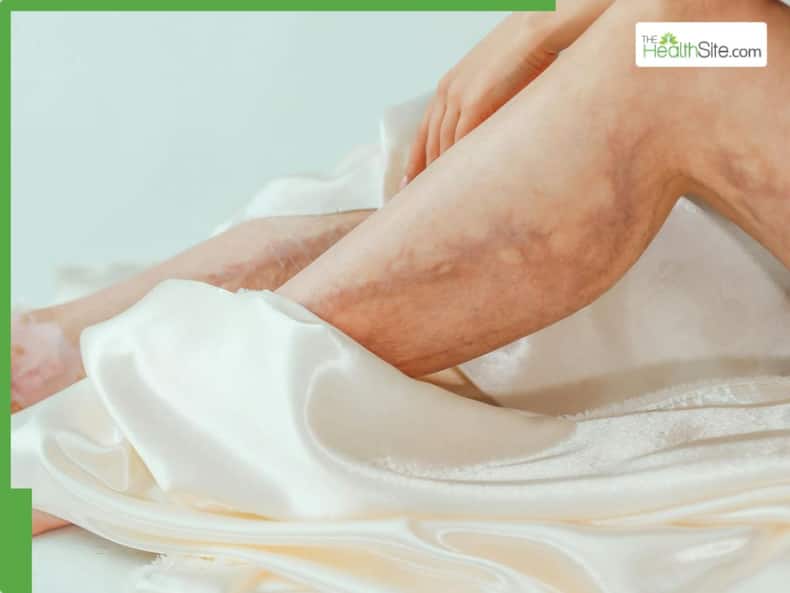 Peripheral Artery Disease: 6 Warning Signs Of Blocked Arteries That Appear In The Legs