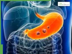 5 Fast-Growing Stomach Cancers Linked to Diet and Lifestyle Choices