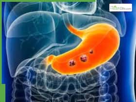 5 Fast-Growing Stomach Cancers Linked to Diet and Lifestyle Choices