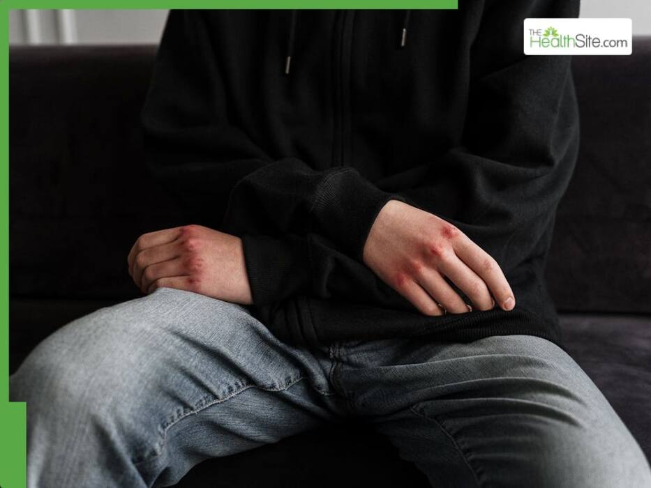 Alcoholic Fatty Liver Symptoms: 7 Warning Signs That Show Up In Your Hands