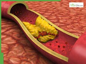 High Cholesterol Control Tips: 7 Empty Stomach Drinks To Flush Out Bad LDL Cholesterol Naturally