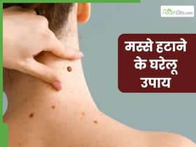 चेहरे से अनचाहे मस्से हटाने के लिए आजमाएं ये 5 घरेलू उपाय, नहीं दिखेगा एक भी दाग
