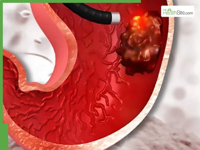 5 Fast-Growing Stomach Cancers Linked to Diet and Lifestyle Choices
