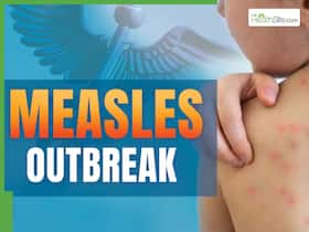 Measles Outbreak Worsens In Sydney: Safety Tips Amid Rapid Spread In New South Wales Measles Outbreak Worsens In Sydney: Safety Tips Amid Rapid Spread In New South Wales