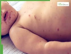 Child Dies From Rare Measles Complication: What is SSPE? Here's All About Its Deadly Impact