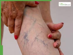 Varicose Veins: 5 Effective Home Remedies For Bulging Veins