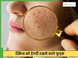 एक्ने ठीक करने के लिए क्या खाएं और क्या न खाएं?