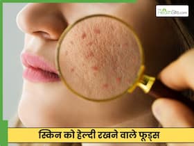 एक्ने ठीक करने के लिए क्या खाएं और क्या न खाएं?