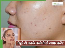चेहरे से तिल जैसे काले धब्बे कैसे हटाएं? जानें 2 नुस्खे, जो देंगे साफ चमकता चेहरा