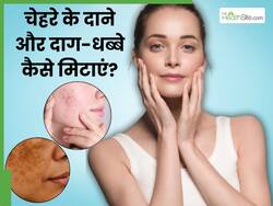 पिंपल्स और दाग-धब्बे मिटाने लगाएं घर पर मौजूद ये 5 चीजें, कई गुना बढ़ जाएगा त्वचा का निखार