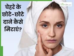 चेहरे के छोटे- छोटे दाने मिटाने के लिए क्या लगाएं? जानें 5 चीजें जिनसे दूर होगी समस्या