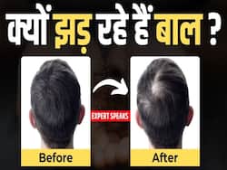 क्यों तेजी से झड़ रहे हैं बाल, Doctor ने बताया ये है बड़ा कारण!