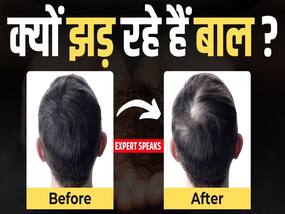 क्यों तेजी से झड़ रहे हैं बाल, Doctor ने बताया ये है बड़ा कारण!