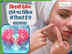 स्किन में दिखने वाले लक्षण सिर्फ नहीं एलर्जी ही नहीं बल्कि हो सकते हैं किडनी डैमेज का संकेत, कैसे लगाएं पता