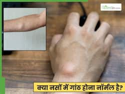 क्या नसों में गांठ होना नॉर्मल है? जानें नसों को ठीक होने में कितना समय लगता है?