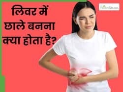 लिवर में छाले बनना क्या होता है? जानें इसके कारण, लक्षण और इलाज