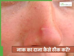 नाक के ऊपर दाने होने पर क्या करें? जानें 2 टिप्स, जो दूर करेंगी दर्द वाले फोड़ों की समस्या