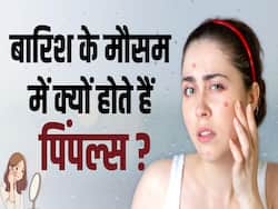 बारिश के मौसम में होने वाले पिम्पल से कैसे बचें?