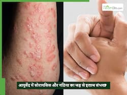 क्या सोरायसिस व गठिया जैसी ऑटोइम्यून बीमारियों को जड़ से खत्म कर सकता है आयुर्वेद?
