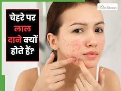 चेहरे पर लाल दाने को कैसे ठीक करें? जानें 5 उपाय, जो दूर करेंगे स्किन एलर्जी